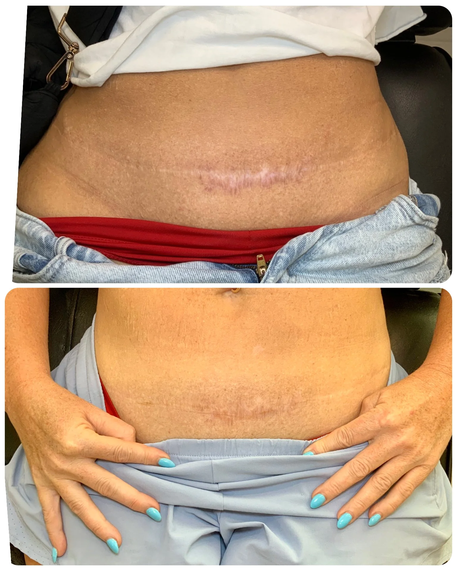 Abdominal scar camouflage comparison