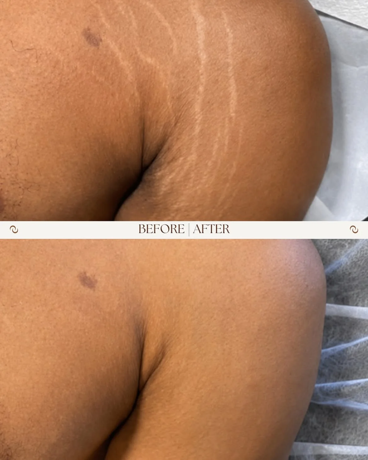 Shoulder scar camouflage before and after comparison